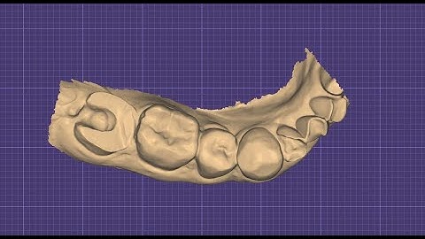 Onlay/overlay/table top molar crown designing in exocad