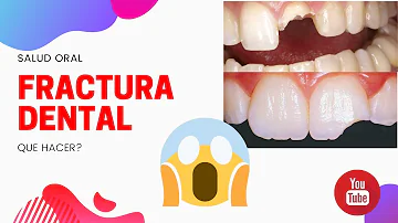 ¿Un diente roto es permanente?
