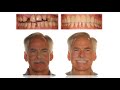 Dental Treatment: Accelerated Orthodontics Dec 5, 2017