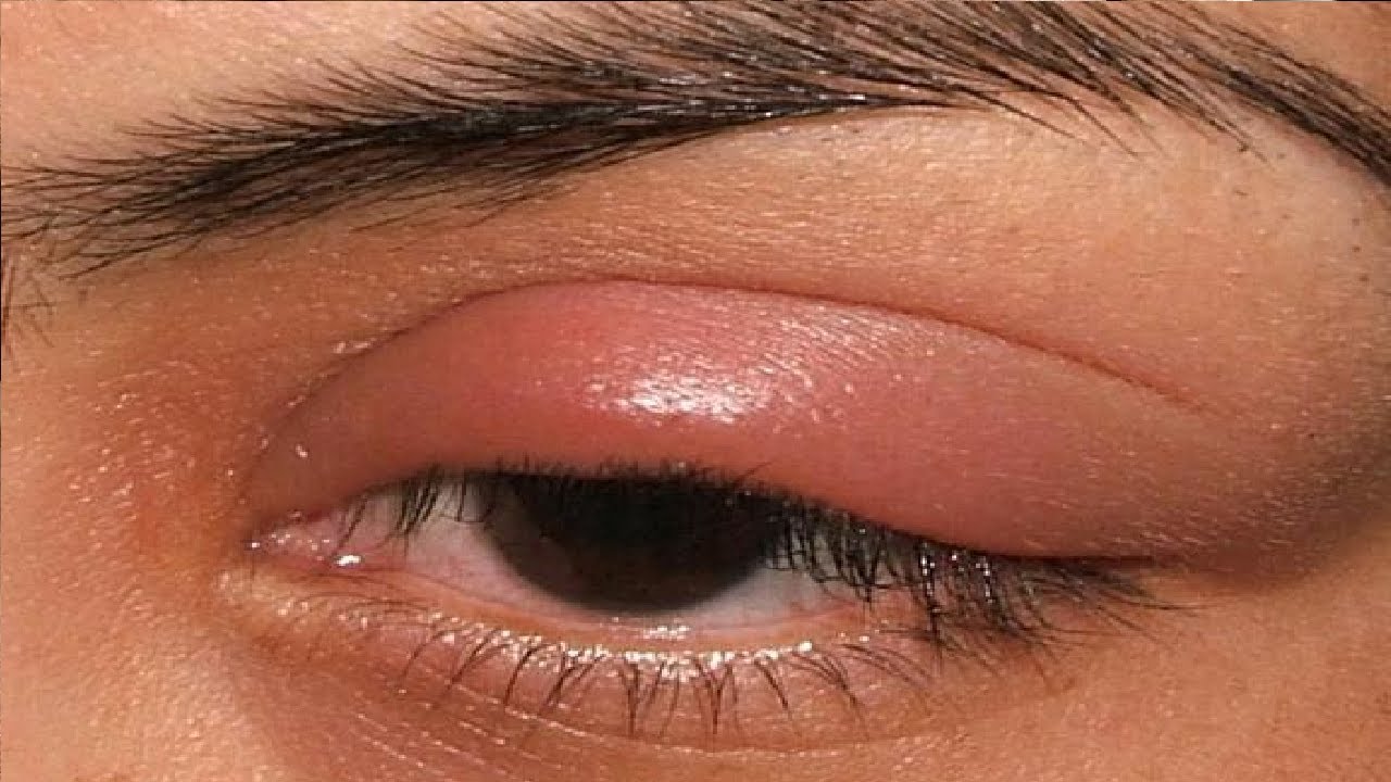 how to get rid of a stye with eyelash extensions - YouTube
