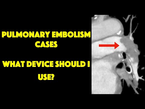 Pulmonary Embolism Thrombectomy Devices: The Basics