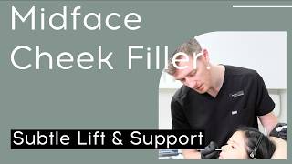 Midface Cheek Filler: Subtle Lift & Support | OSO Clinic