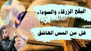 ظهور بقع زرقاء  هل من المس اوا الجن العاشق