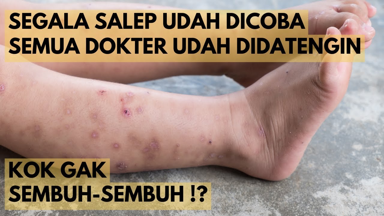 Kenapa PENYAKIT KULIT Kalian SUSAH SEMBUH