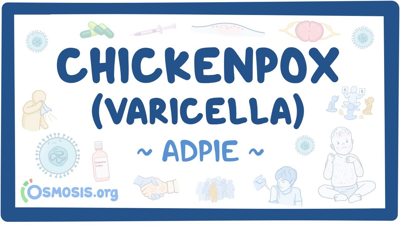 Chickenpox (Varicella): Nursing Process (ADPIE)