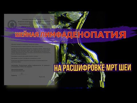 ЛИМФАДЕНОПАТИЯ шейных лимфоузлов на расшифровке МРТ мягких тканей шеи