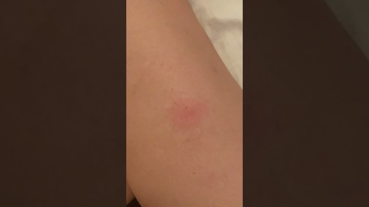 Scratching mosquito bite with bottle cap 2