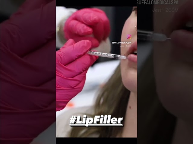 Lip Filler Fridays