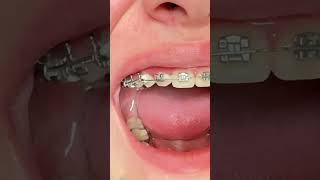 Braces On - Rotation Wedges - Toothtime Family Dentistry Orthodontics New Braunfels tx