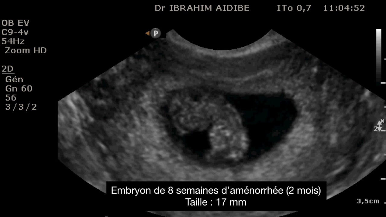 Echographie de grossesse à 22 semaines d'aménorrhée 