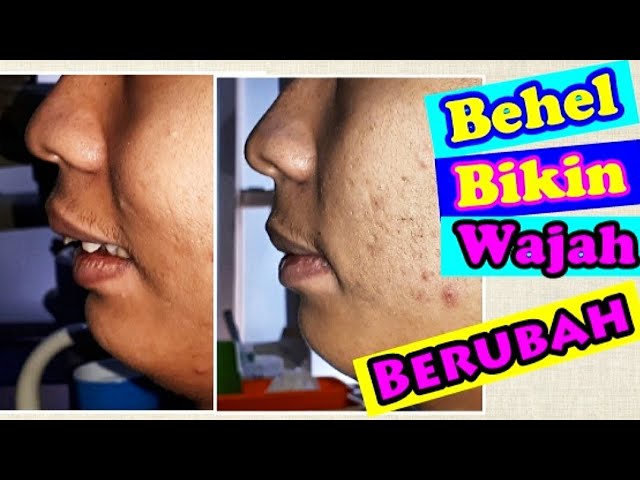 Bibir Tebal Pakai Behel Gigi Merubah Bentuk Wajah Dokter Gigi Jogja Menjelaskan Youtube Bibir Tebal Pakai Behel Gigi Merubah Bentuk Wajah Dokter Gigi Jogja Menjelaskan Youtube
