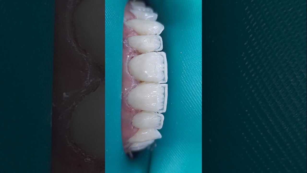 ☝️COMO SÃO FEITO AS FACETAS EM RESINAS! #facetasdentarias #dentista