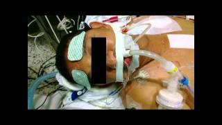 Tipos de edema cerebral 4