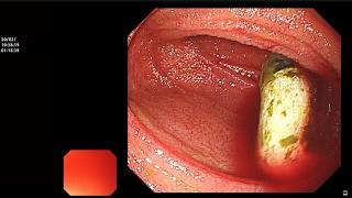 RETRIEVAL OF RETAINED VIDEO CAPSULE USING SINGLE BALLOON ENTEROSCOPY