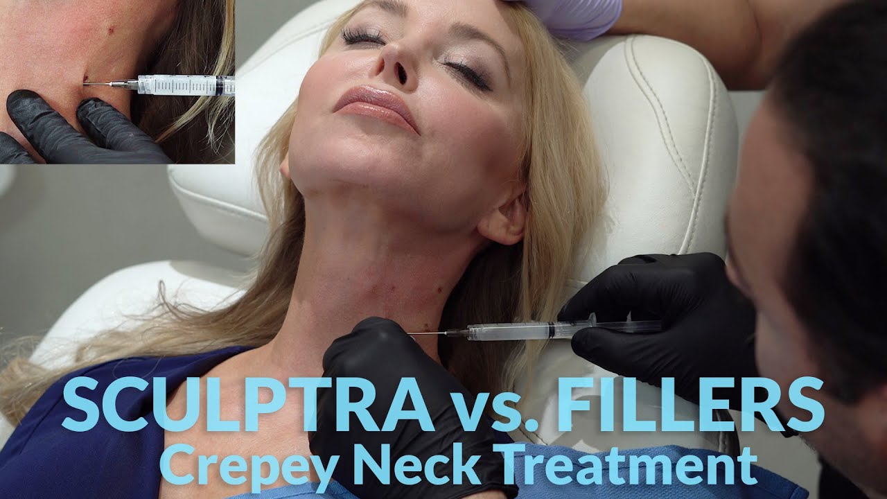 Filler vs. Sculptra - Crepey Neck Treatment Over 50