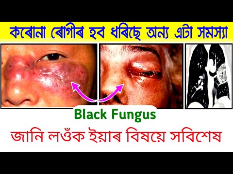 কৰোনা ৰোগীৰ হব ধৰিছে অন্য এটা সমস্যা | What is Black Fungus or Mucormycosis