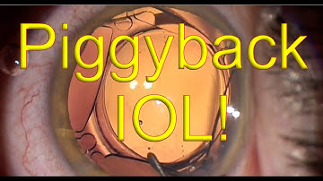 Piggyback IOL for refractive surprise after cataract surgery (1stQ AddOn lens) - Dr Simon Chen