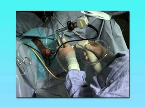 holep prostata op holep prostata op