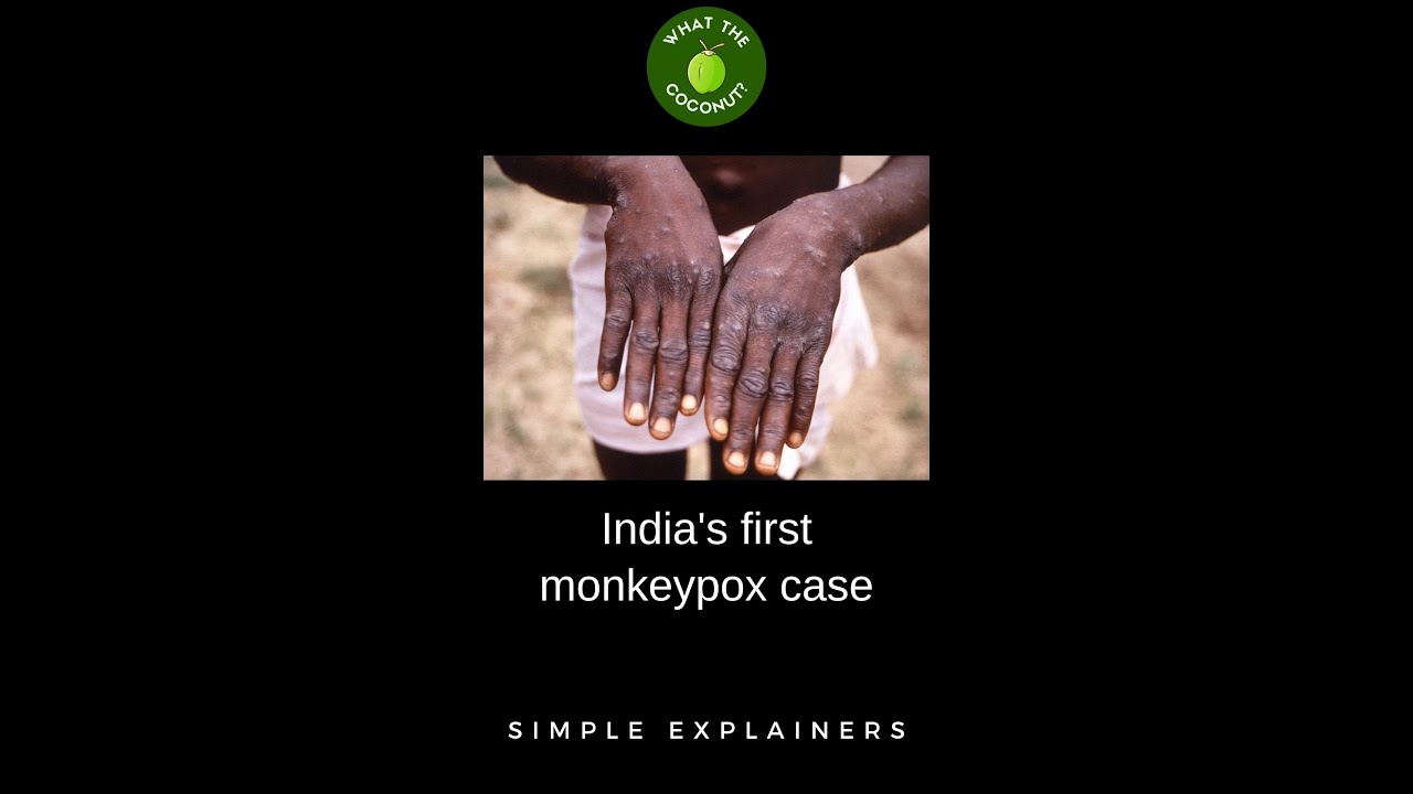 ⁣First monkeypox case of India reported in Kerala