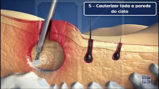 EPSIT (Endoscopic Pilonidal Sinus Treatment) - Tratamento Endoscópico do Cisto Pilonidal