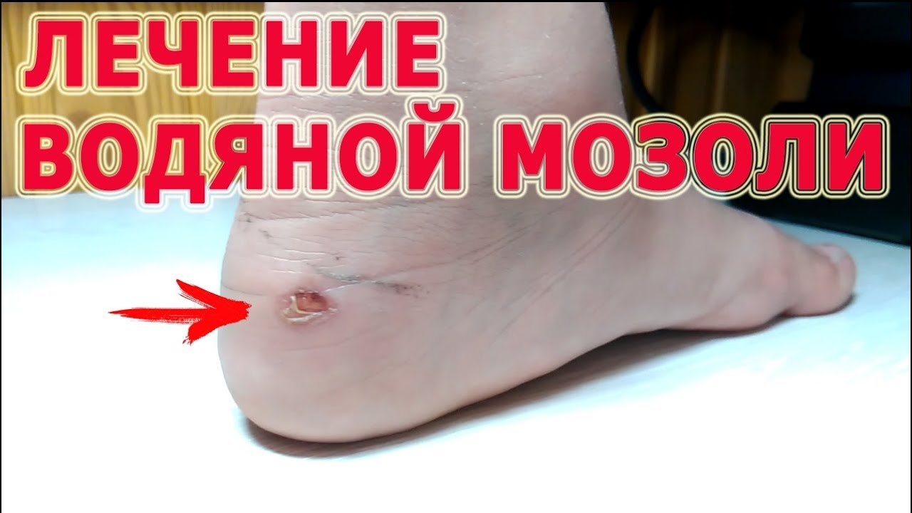 Лечение водяной мозоли. Лечение лопнувшей мозоли-водянки. - YouTube