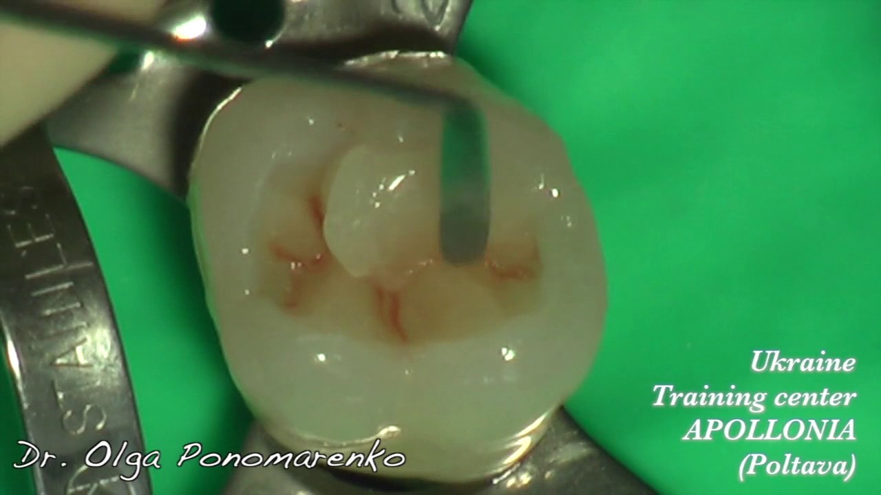 Ольга Пономаренко “Комбинация SDR+Ceram X+Enhance Multi”