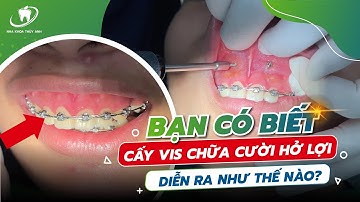 Điều Trị Cười Hở Lợi Bằng Niềng Răng Hiệu Quả Như Thế Nào?