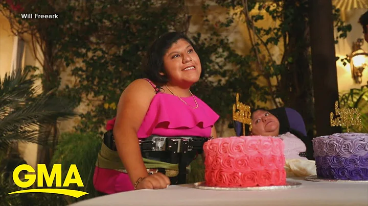 Formerly conjoined twins celebrate 21st birthday