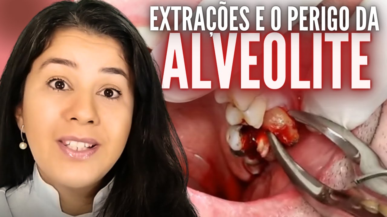 Dente Inflamado O Que Fazer – Raiz do dente inflamada: 5 causas e como ...