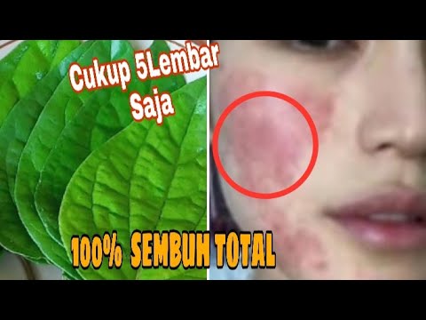 Obat Biduran Parah