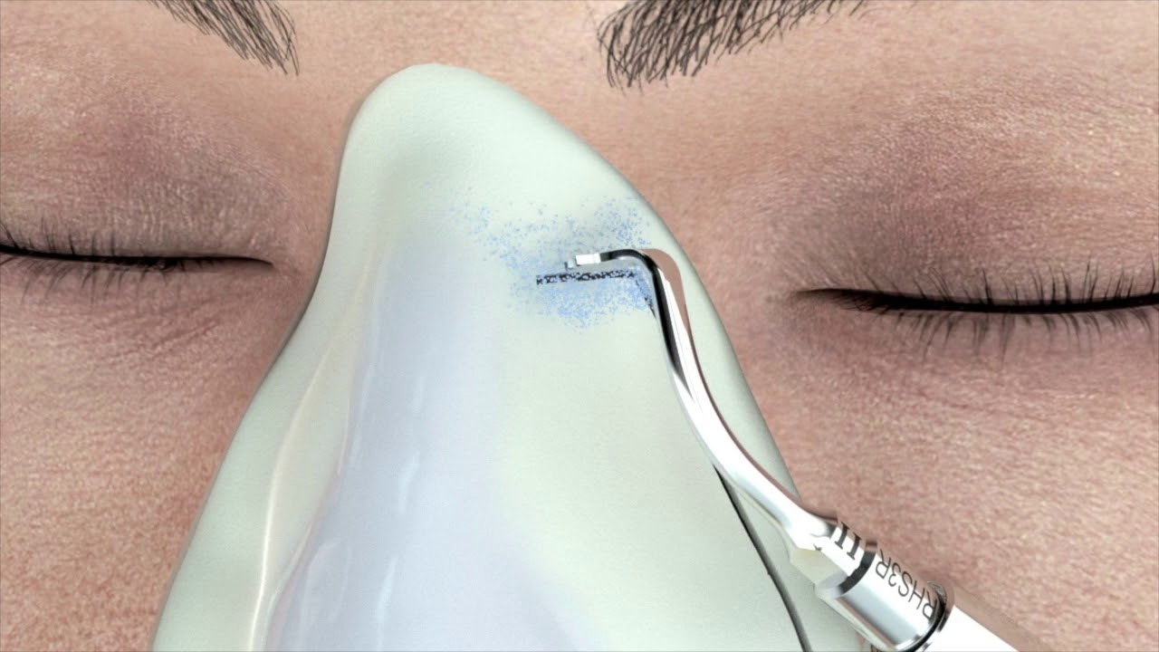 Julian Rowe Jones - Piezo Rhinoplasty Cartoon