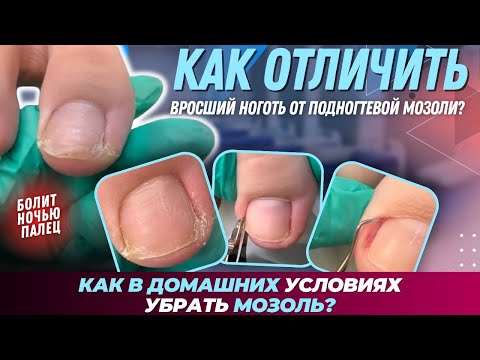 Как в домашних условиях убрать мозоль? / Как отличить вросший ноготь от подногтевой мозоли? #мозоль