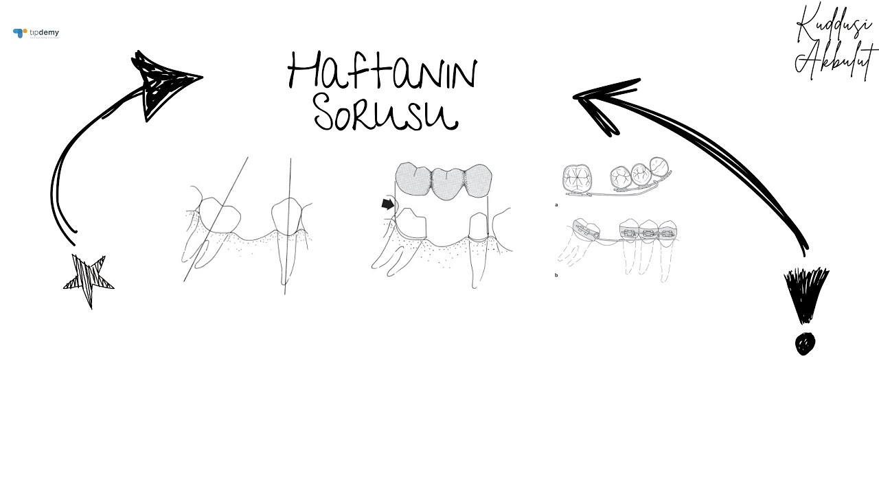 Haftanın Sorusu - Devrilmiş Azı Dayanaklar ve Çözüm Alternatifleri