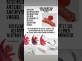 Hirnaneurysma Behandlungs möglichkeiten #flowdiverter #stent #endovascular