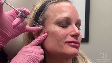 Cheek Filler to achieve the Ogee curve