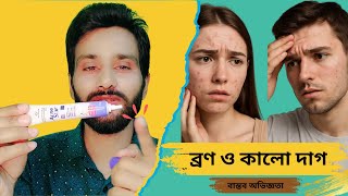 মুখের ব্রণ ও কালো দাগের সমস্যার সমাধান | তৈলাক্ত ত্বক ও ব্রণ দূর করার জন্য স্পেশাল গাইড screenshot 1