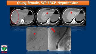 Liver Perforation following ERCP Video @yaleradiology