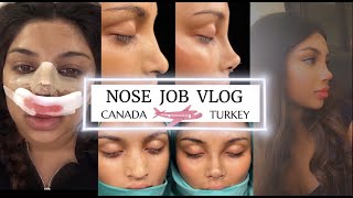 NOSE JOB (RHINOPLASTY) IN TURKEY VLOG | Dr.Resit Burak Kayan | Full Experience+Cast Off Nose Reveal!