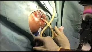 METAL CUP VACUUM EXTRACTION VIDEO BY Dr.JAYA PRAKASH PATIL, RAICHUR screenshot 4