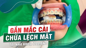 Quá Trình Gắn Mắc Cài Diễn Ra Như Thế Nào ?