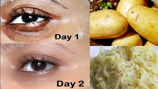 100% Natural And Effective Home Remedy For Dark Circles In Hindi Sajal Areej Hacks