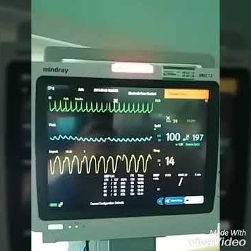 Ngeri liat monitor pasien bgini , pasien yg mauuu......