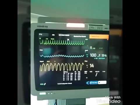 Video: Apakah alat pacu jantung mengeluarkan suara berdetak?