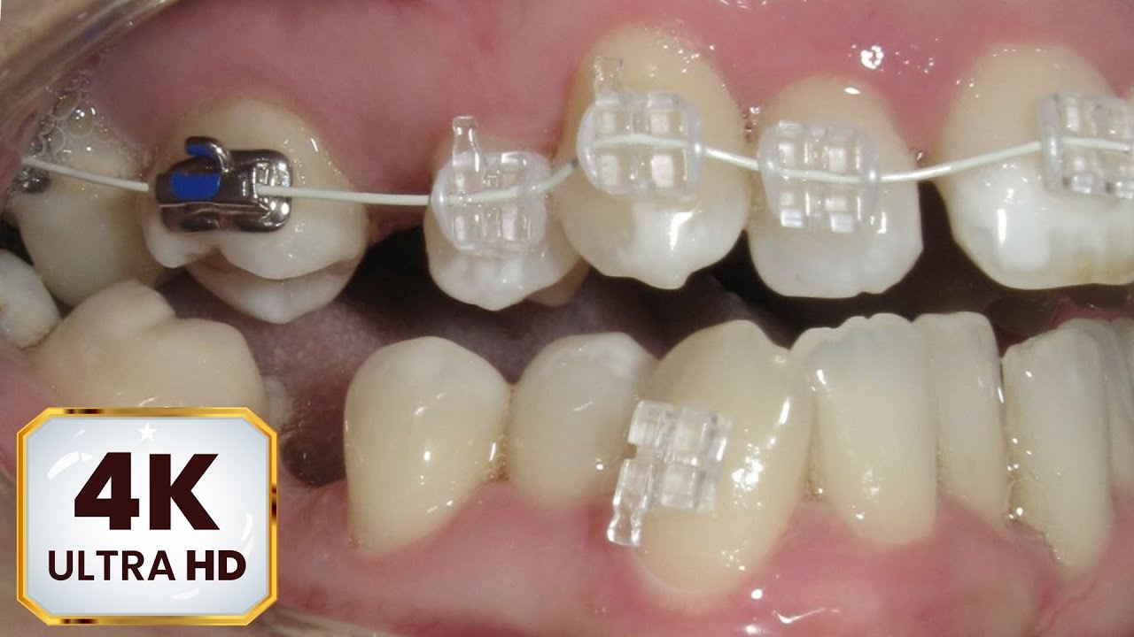 HOW BRACES WORK Sapphire braces. Protruding chin in ADULT patient! 4k