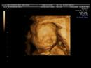 Echo 3D fetus de 20 semaines
