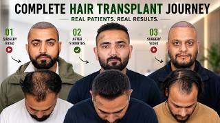 Hair Transplant in India (HX-JUHY) | Best Results &amp; Cost of Hair Transplant in  India.