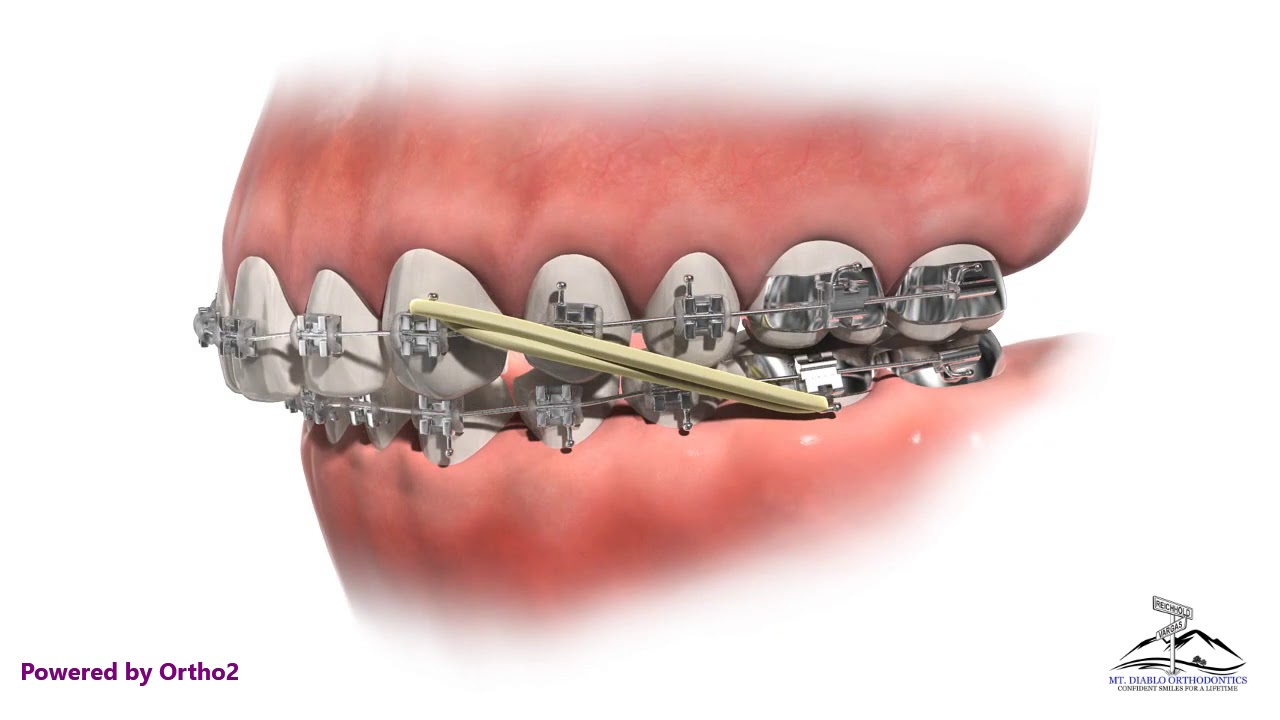 Orthodontic Appliances Explained