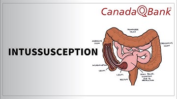 Intussusception: Causes, Symptoms & Treatment | Pediatrics Made Simple | CanadaQBank