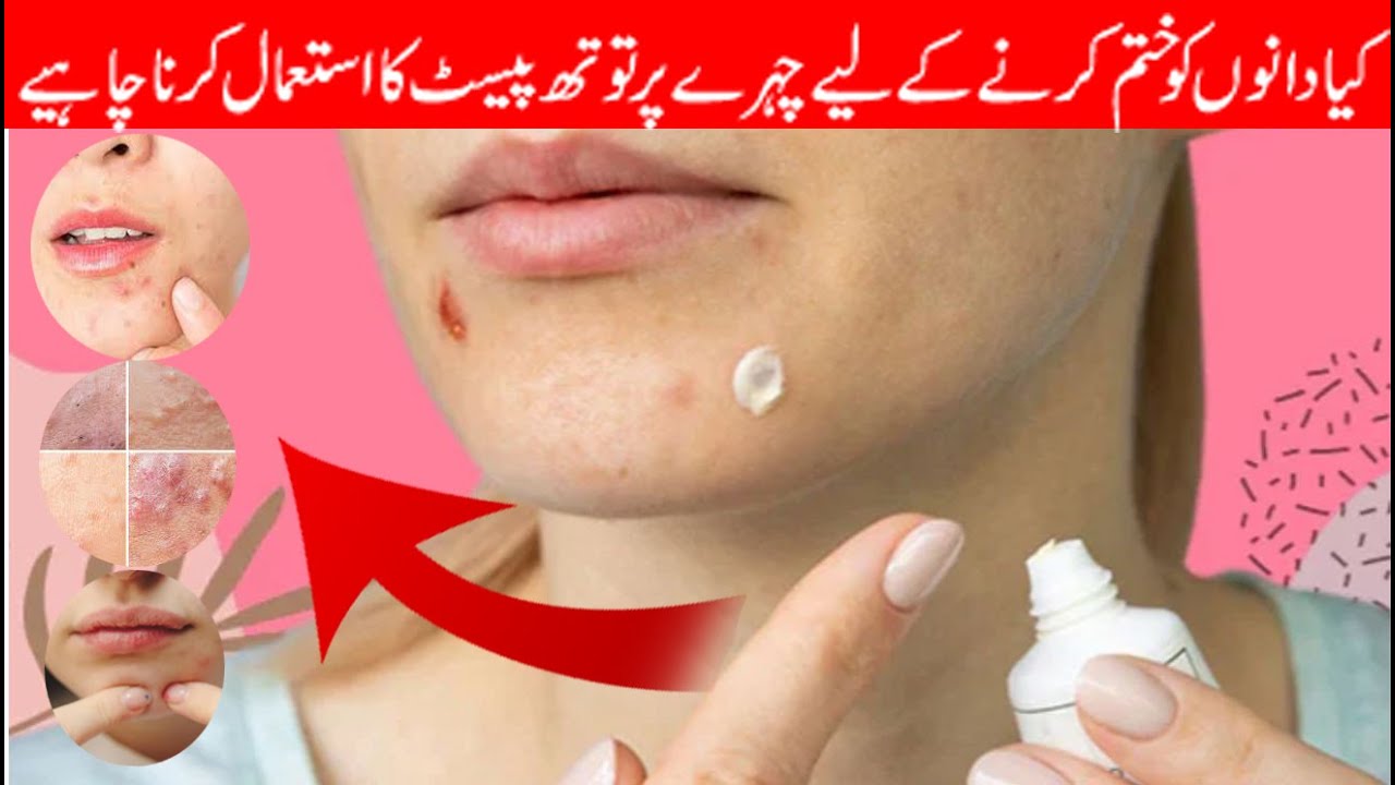 Should toothpaste be used on the face to get rid of pimples quickly?  