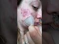 Best pimple popping peels by fazit